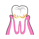 プラーク（歯垢）の害